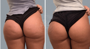 7 Secrets to achieving a natural bbl 2 cellulite butt